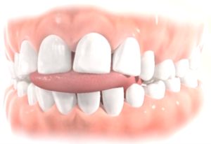 denti