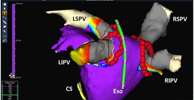 aritmie cardiache